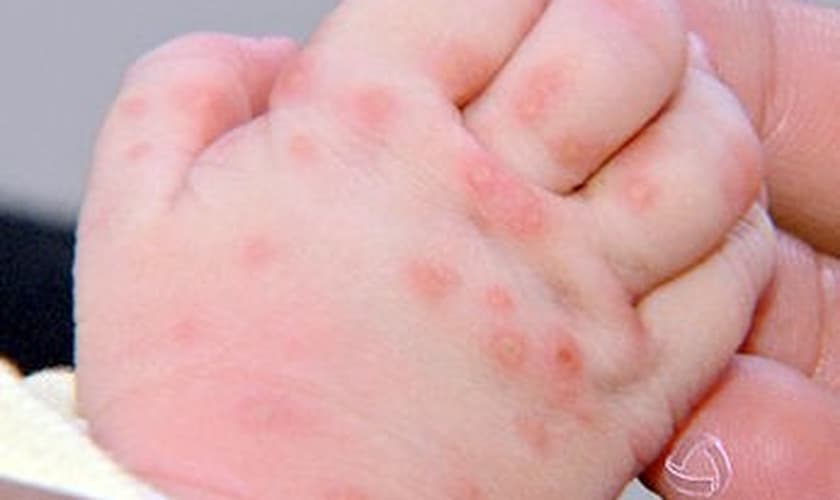 Bebê recém-nascido tinha marcas de picadas de inseto pelo corpo