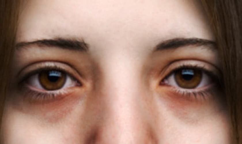 tratamento para cada tipo de olheiras